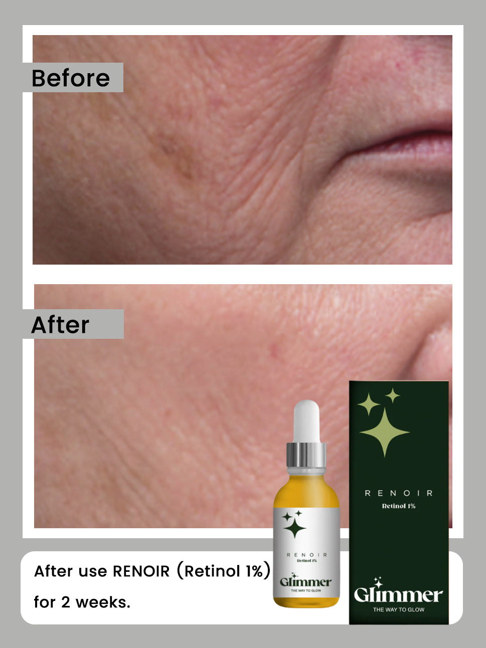 RENOIR (Retinol 1%)